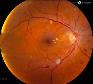 moderate Hypertensive retinopathy
