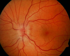 NAION with Optic Disc Swelling