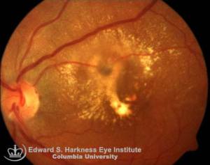 RAM with widespread leakage of lipid into the surrounding retina