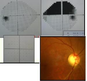 Visual field loss associated with stroke