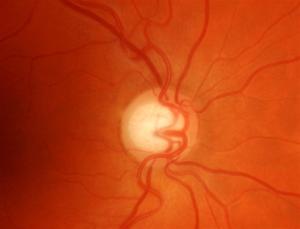 Optic Nerve with Moderate Glaucoma damage