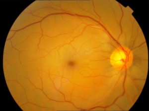 CRAO. Macula appears as a "Cherry Red Spot" due to underlying blood supply