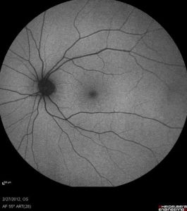 Autofluorescent image of a normal retina