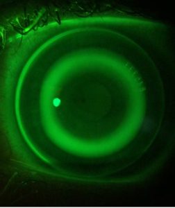 An Ortho-K Retainer on the eye with fluorescein dye