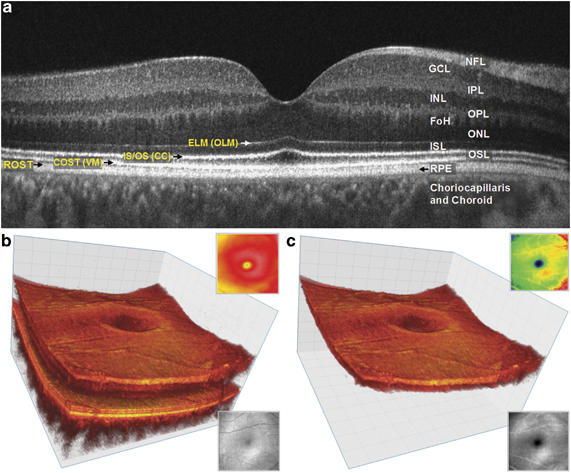 3-D Retinal Imaging