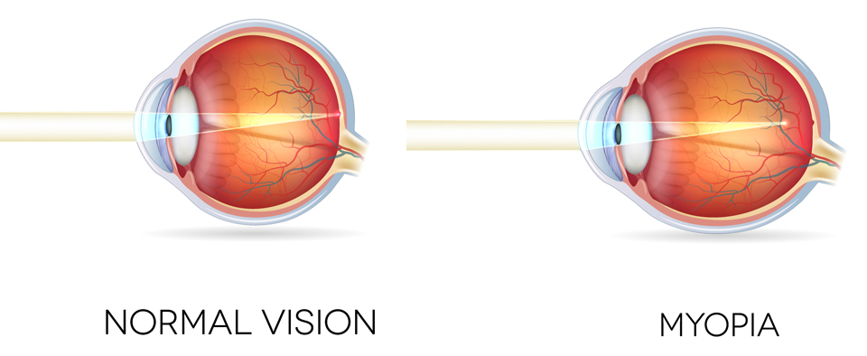 New Myopia Control | Optometrist Paducah Kentucky, Eye Doctor Paducah KY