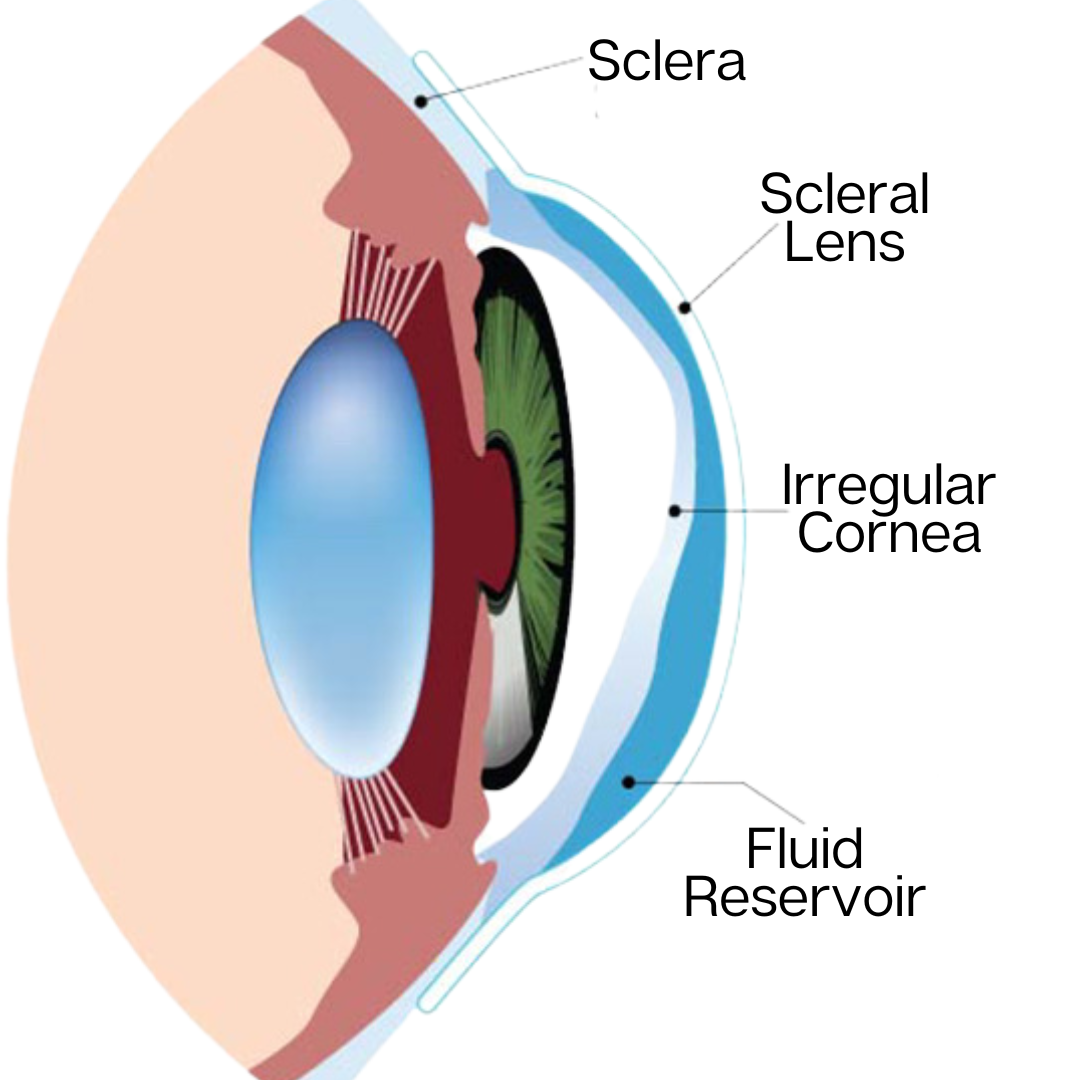 Trouble-shooting the Fit of a Custom Soft Contact Lens